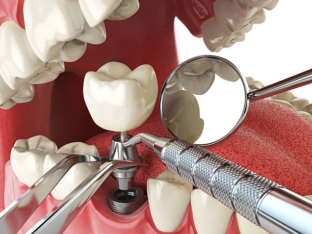 Best Emergency Root Canal Treatment in Parksdale, CA